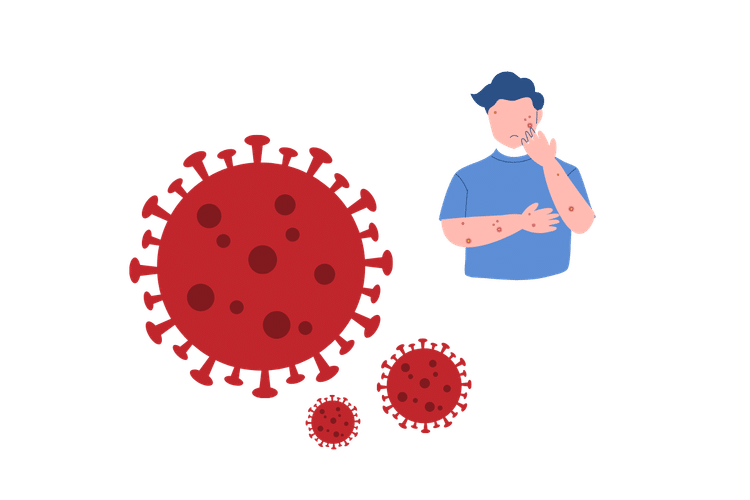 Illustration of Mpox showing the virus and a person with skin lesions